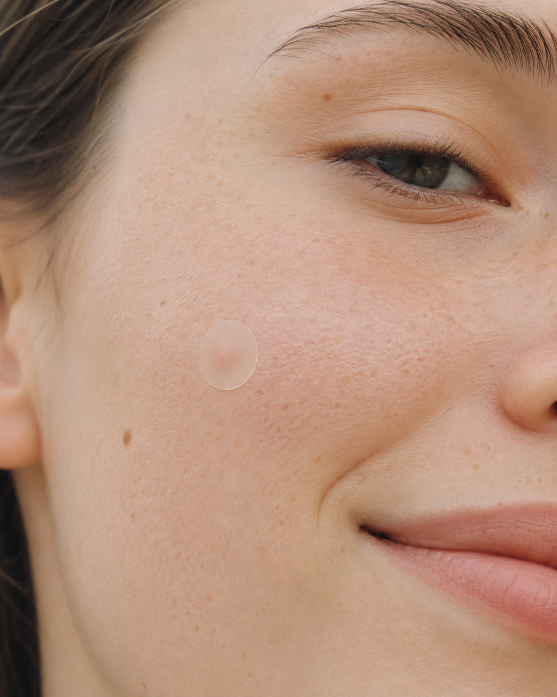 Hydrocolloid Patches 101: How They Work and Why They Matter
